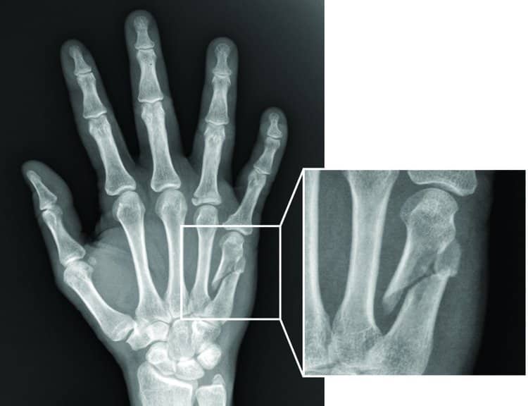 Bệnh Gãy xương bàn tay: Nguyên nhân, biến chứng và cách điều trị